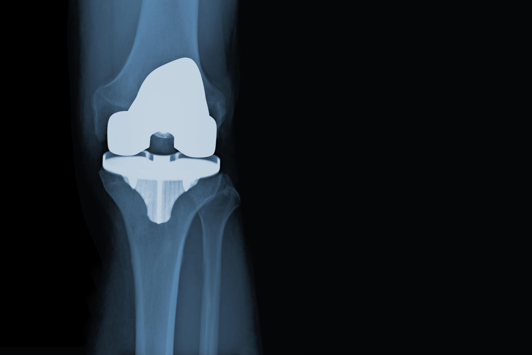 Pennsylvania Exactech Knee Replacement Attorneys Exactech Recall Lawyers